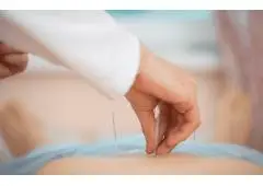 Electroacupuncture NYC